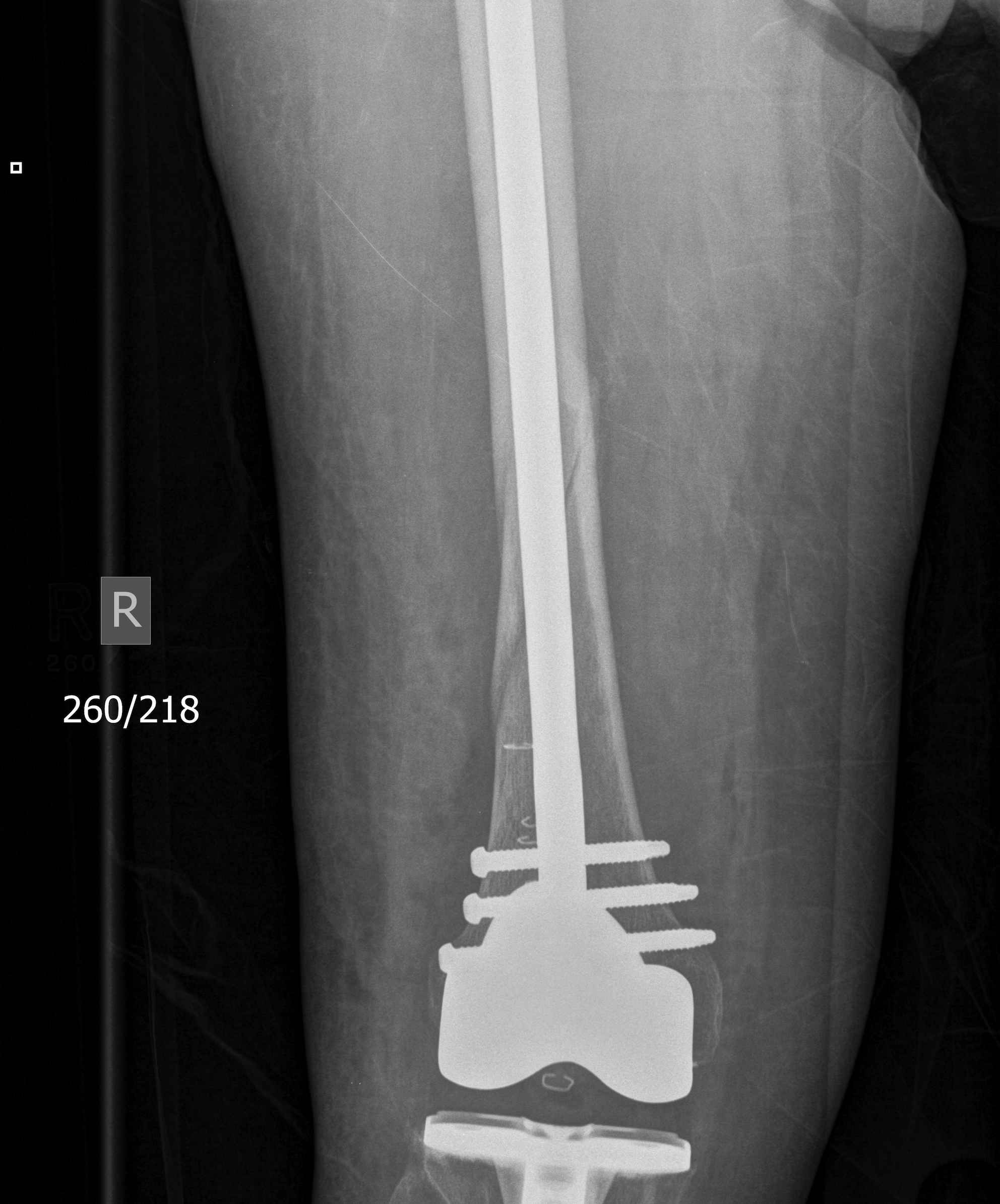 TKR Periprosthetic Fracture Retrograde Nail 1